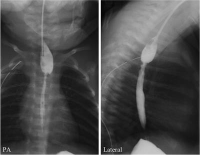 Refractory tracheoesophageal fistula treated using multi-stage surgery: A case report